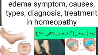 what is edema symptom causes types diagnosis treatment in homeopathy medicine [upl. by Vasta]