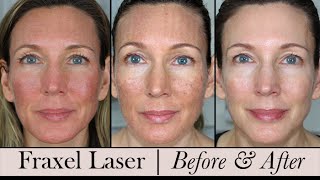 Fraxel Face Laser  Before amp After 3 Month Update [upl. by Mairim]