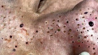 Big Cystic Acne Blackheads Extraction Blackheads amp Milia Whiteheads Removal Pimple Popping  5396 [upl. by Adnik477]