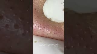 Pimple Satisfy acne removal Blackhead removal88acne pimples shorts [upl. by Ahel]