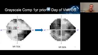 Optic Nerve and Retinal Rounds From Nerveracking to Nuanced [upl. by Eirelav]