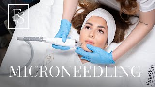 Rejuvenation RF Microneedling  Behandlungsablauf  FineSkin [upl. by Annaig]