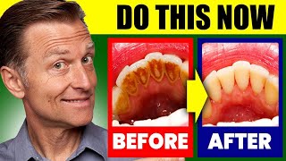 Natural Solution for Plaque Cavities and Gingivitis [upl. by Hightower]