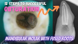 Obturation in Mandibular Permanent Molar with Fused Roots 🟠 12 points To Successful Obturation 🔵 [upl. by Eiten331]