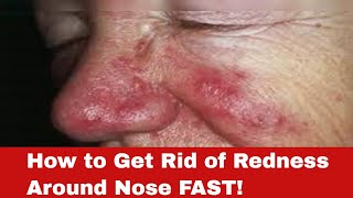 Red Nose No More How to Get Rid of Redness Around Nose FAST [upl. by Meletius]