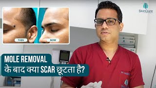 Scar after Mole Removal  Mole surgery in Delhi  Mole removal by Laser  SkinQure  Dr Jangid [upl. by Nneb]