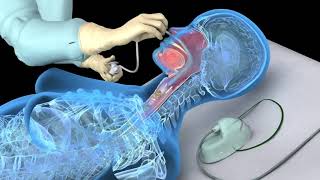 Nasotracheal suctioning NTS  3D animation [upl. by Eiger730]