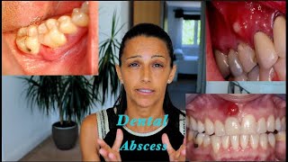 How to treat a Dental Abscess Different Natural Mouthrinses and their uses [upl. by Greene]