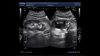 Ultrasound Video showing renal Angiomyolipoma with stones at PUJ [upl. by Odragde]