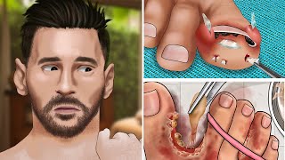 ASMR Ingrown Toenail Removal Animation  Remove glass shards stuck in Toes [upl. by Attennyl386]