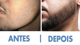 Minoxidil Kirkland  Barba  Antes e Depois  11 Meses [upl. by Keelin]