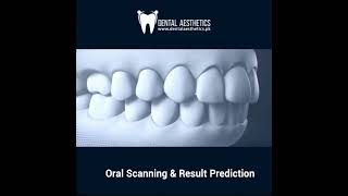 Invisalign Clear Aligners Before and After 3D Animation  Teeth Straightening [upl. by Rabjohn190]