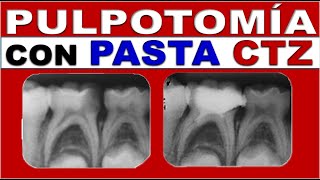 TRATAMIENTOS ENDODONCIA NO INSTRUMENTADOS INFANTILES DIENTES TEMPORALES [upl. by Natalee224]