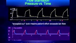 Mechanical Ventilation Waveform Analysis [upl. by Amary830]