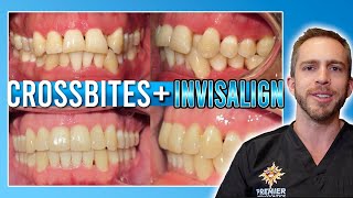 Invisalign Crossbite Treatment BEFORE amp AFTER [upl. by Floss]