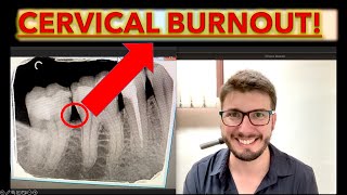 Cervical Burnout or Caries How to Know theories of dental caries in teeth cavity ICDAS x ray [upl. by Samira]