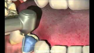 Crowns  Procedure for your new crown at Dental Reflections [upl. by Elkcim]