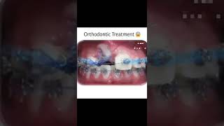 Ortho Treatment For Teeth advanceddentistry orthodontist orthodontics [upl. by Nnyletak525]