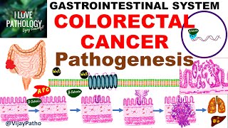 Colorectal carcinoma  Epidemiology risk factors amp Pathogenesis [upl. by Onairam]