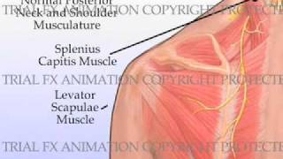 Trigger Point Injections [upl. by Horowitz28]