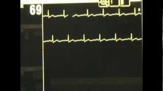 Normal Sinus Rhythm  ACLS Rhythm Recognition and Guidelines [upl. by Hartfield]