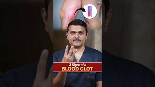 Blood Clot ALERT Catching It Early Saves Lives vascularsurgeon shortsviral [upl. by Ardys]