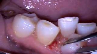 BIOLASE Epulis Removal [upl. by Culosio]