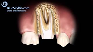 Patient Treatment Videos Root Canal Retreatment [upl. by Wan964]