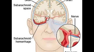 Subarachnoid Hemorrhage [upl. by Selemas]