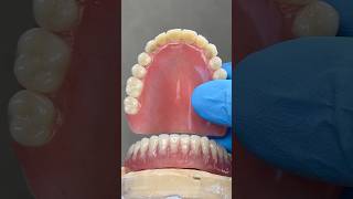 Upper Process and Lower Locator Hybrid Denture lsk121shorts dentist teeth [upl. by Eellac]