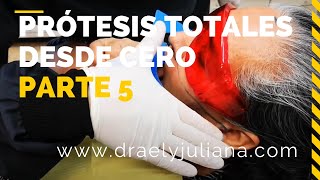 PRÓTESIS TOTALES👅Parte5 DimensiónVertical y Prueba de Rodillos en Cera [upl. by Rocher]