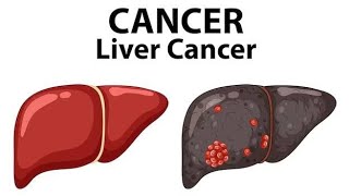 LIVER CANCER BSC NURSINGdailypost [upl. by Kerwinn]