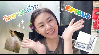 รีวิวการรักษาสิวด้วย Epiduo EPIDUOใช้เฉพาะกลางคืนนะคะ [upl. by Haley891]