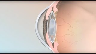 Intraocular Lenses  Mayo Clinic [upl. by Cirri]