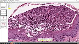 Acute generalized exanthematous pustulosis AGEP pustular psoriasis and SneddonWilkinson [upl. by Anetta724]