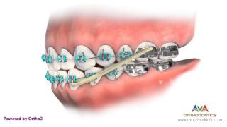 Orthodontics Treatment for Underbite or Crossbite  Rubber Bands [upl. by Eatnoid971]