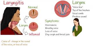 Laryngitis  Symptoms causes and treatment [upl. by Omora]