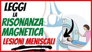 Risonanza magnetica come LEGGERLA  Le LESIONI MENISCALI  Episodio 4 [upl. by Enimasaj]