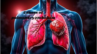 What causes pulmonary embolism Understanding the risks [upl. by Agon706]