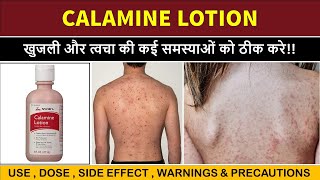 calamine lotion uses  खुजली के लिए बेस्ट लोशन  itching  scabies etc [upl. by Niamjneb]