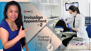 Invisalign Journey Appointment 2 MUST SEE [upl. by Madelene]