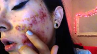 Severe cystic acne accutane week 1 [upl. by Yniar]