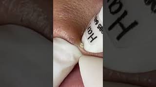 blackheads removal frim the lips [upl. by Analim]