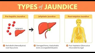 Jaundice  types causes symptoms newborn jaundice diet treatment [upl. by Hulbig]