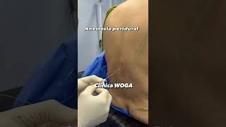 Anestesia en abdominoplastia con lipoescultura anestesiaperidural anestesia [upl. by Stewardson]