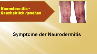 Symptome der Neurodermitis  Ganzmedizin Naturheilpraxis [upl. by Aziza]