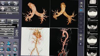 CT Pulmonary Angiography amp Aortography 3D Reconstruction TOSHIBA AQUILION PRIME 160 [upl. by Severson]