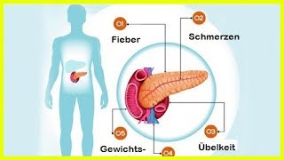 6 Symptome bei Erkrankungen der Bauchspeicheldrüse [upl. by Selij7]