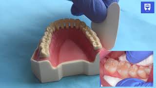 Technique for placing a resin fissure sealant [upl. by Shane]