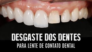 Desgaste dos dentes para lentes de contato dentais e facetas em porcelana [upl. by Anirres]